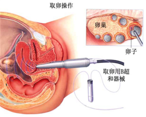 三次体外循环能改变遗传性白发吗